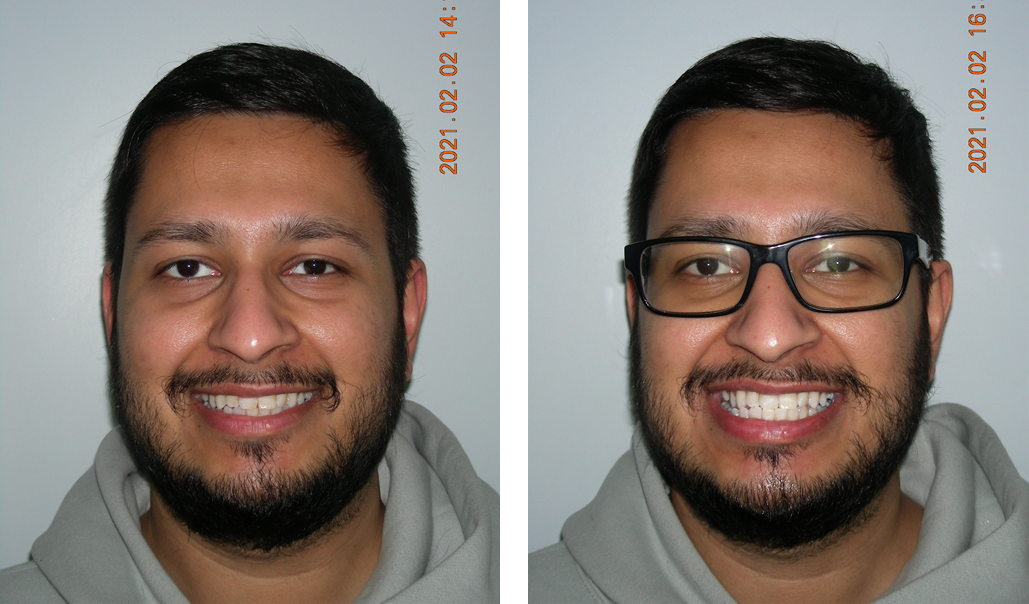 Instant Tooth Whitening