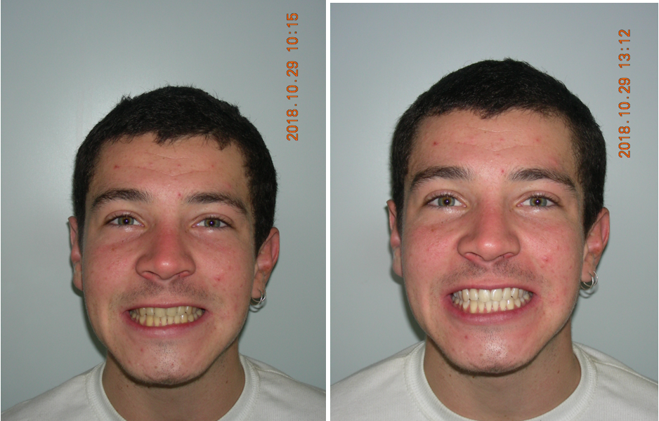 Instant Tooth Whitening